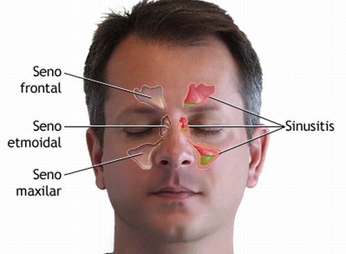 sinusitis