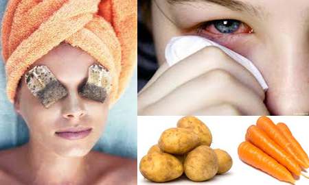 conjuntivitis