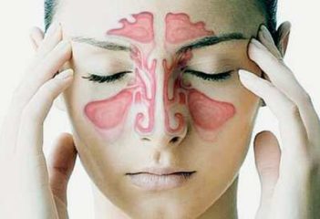 sinusitis