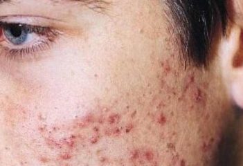 acne